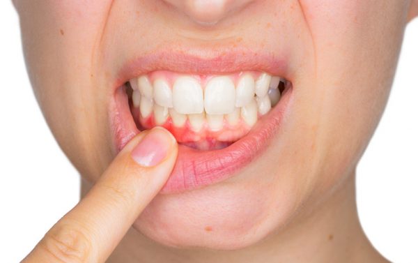 Enfermedad Periodontal: Gingivitis y Periodontitis