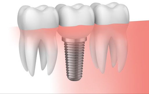 Implante dental. Cuanto duran y como se colocan