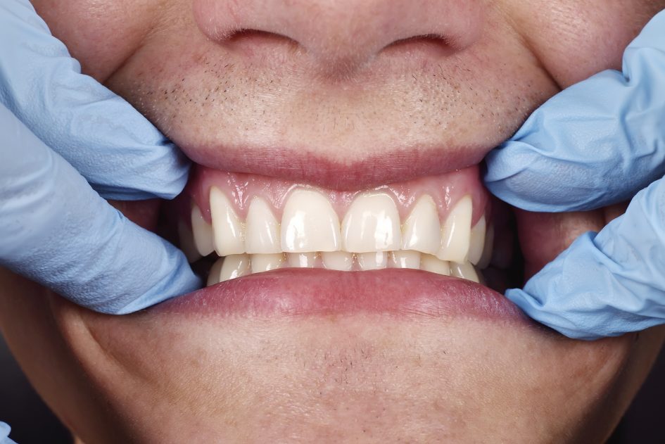 Recesiones gingivales - Diagnóstico y tratamiento