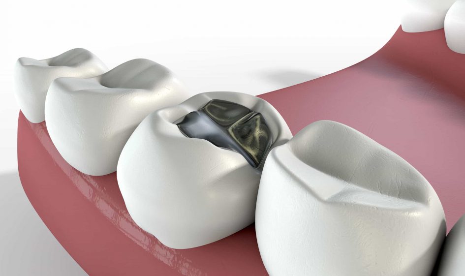 Empastes dentales