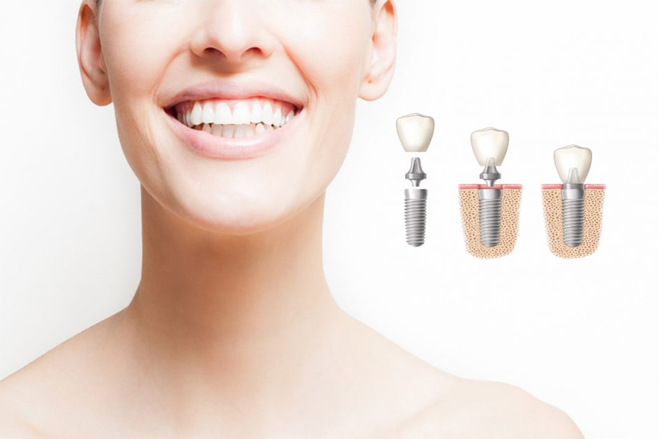 Postoperatorio y cuidado tras implantes dentales