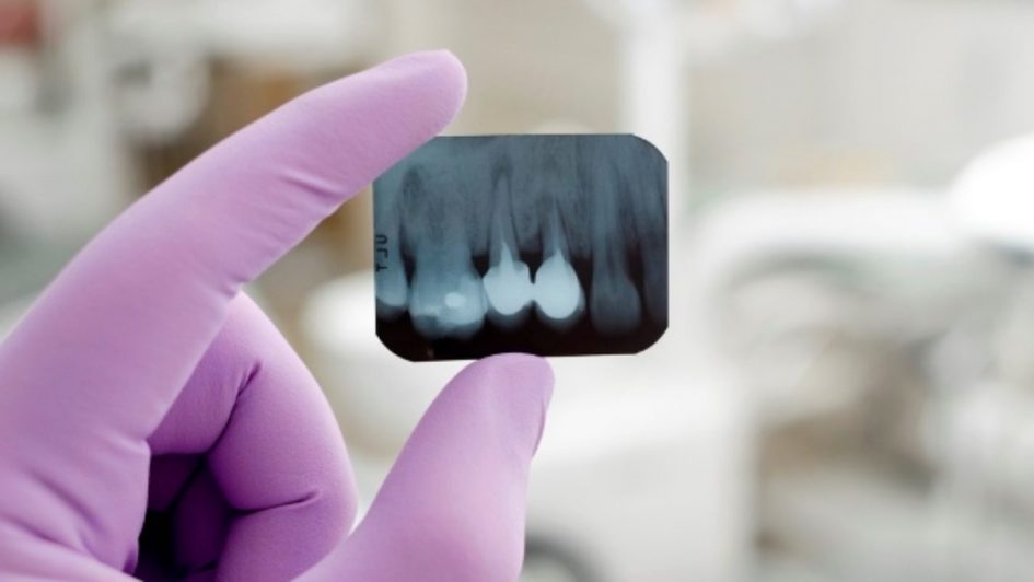 Radiografías dentales - Prueba para el diagnóstico y evaluación