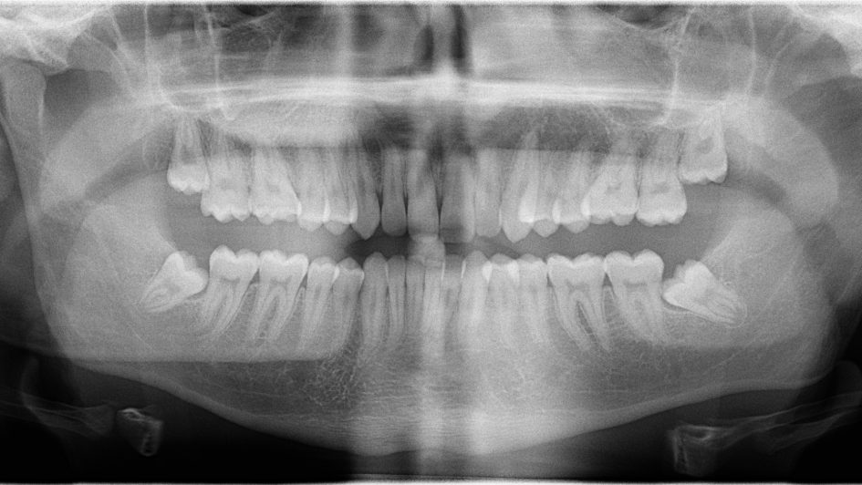 Qué es la fenestración de dientes incluidos